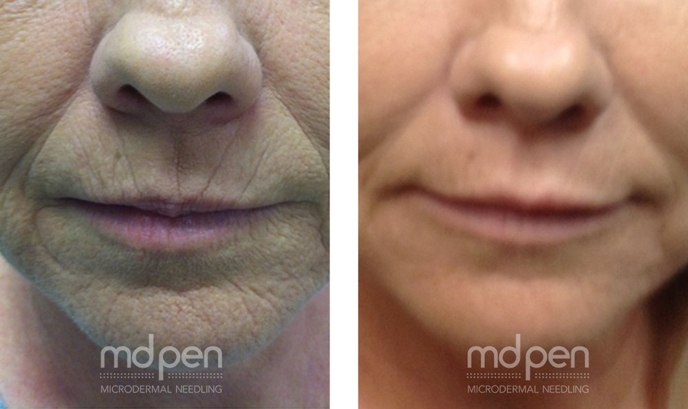 Microneedling before and after, example 1