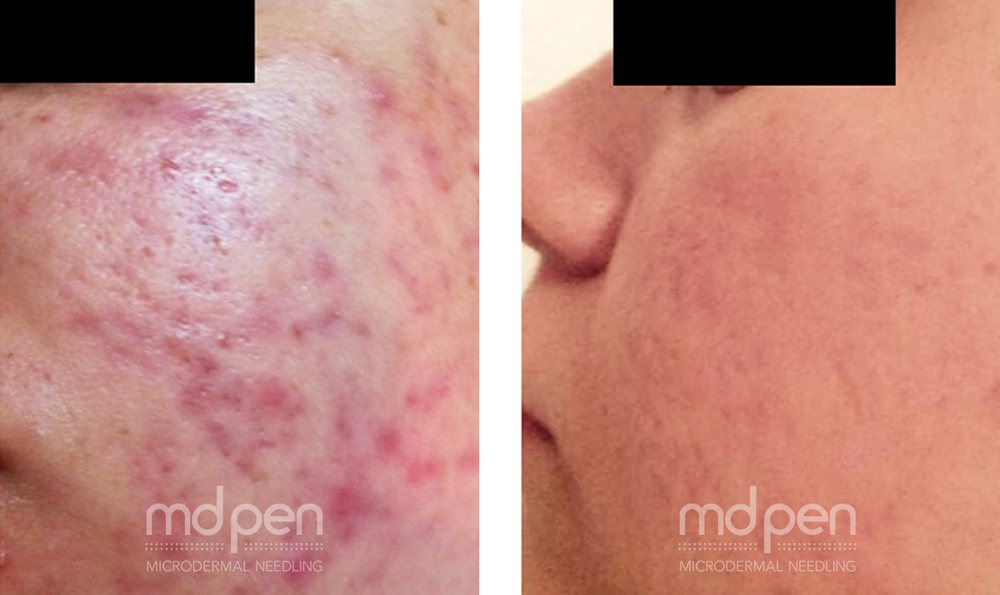 Microneedling before and after, example 2