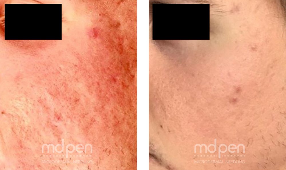 Microneedling before and after, example 3