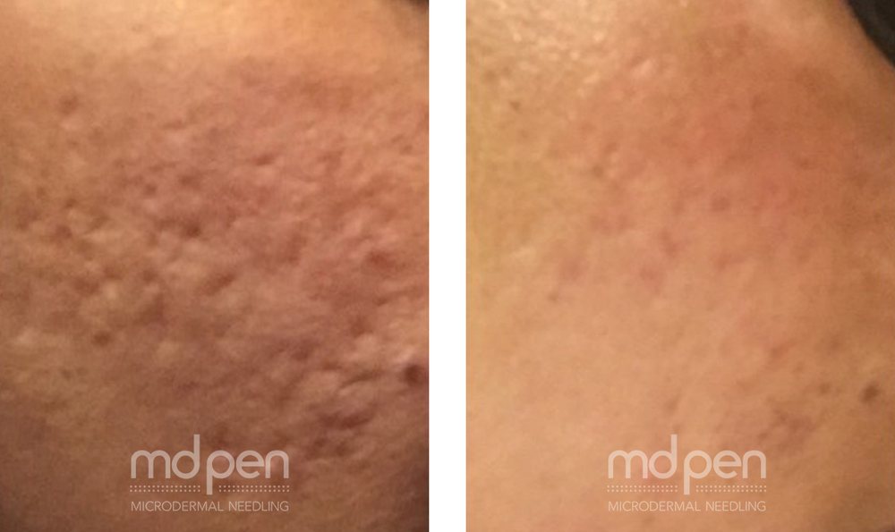 Microneedling before and after, example 4