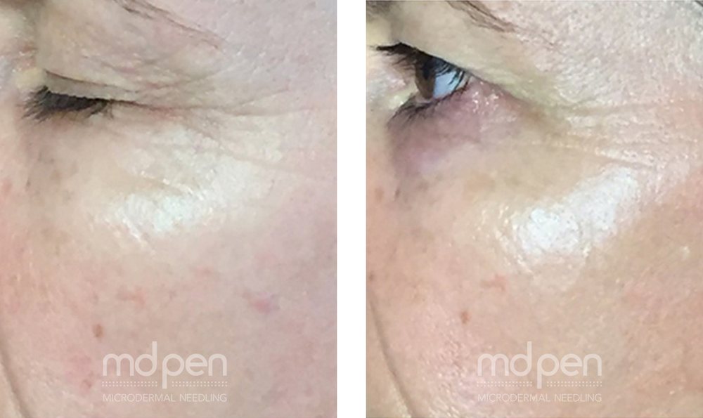 Microneedling before and after, example 5