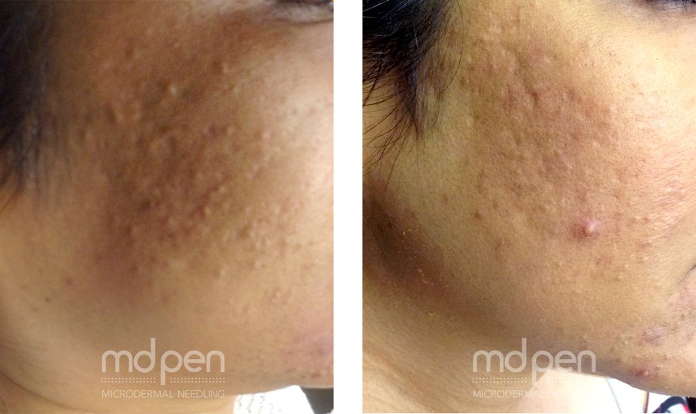 Microneedling before and after, example 6