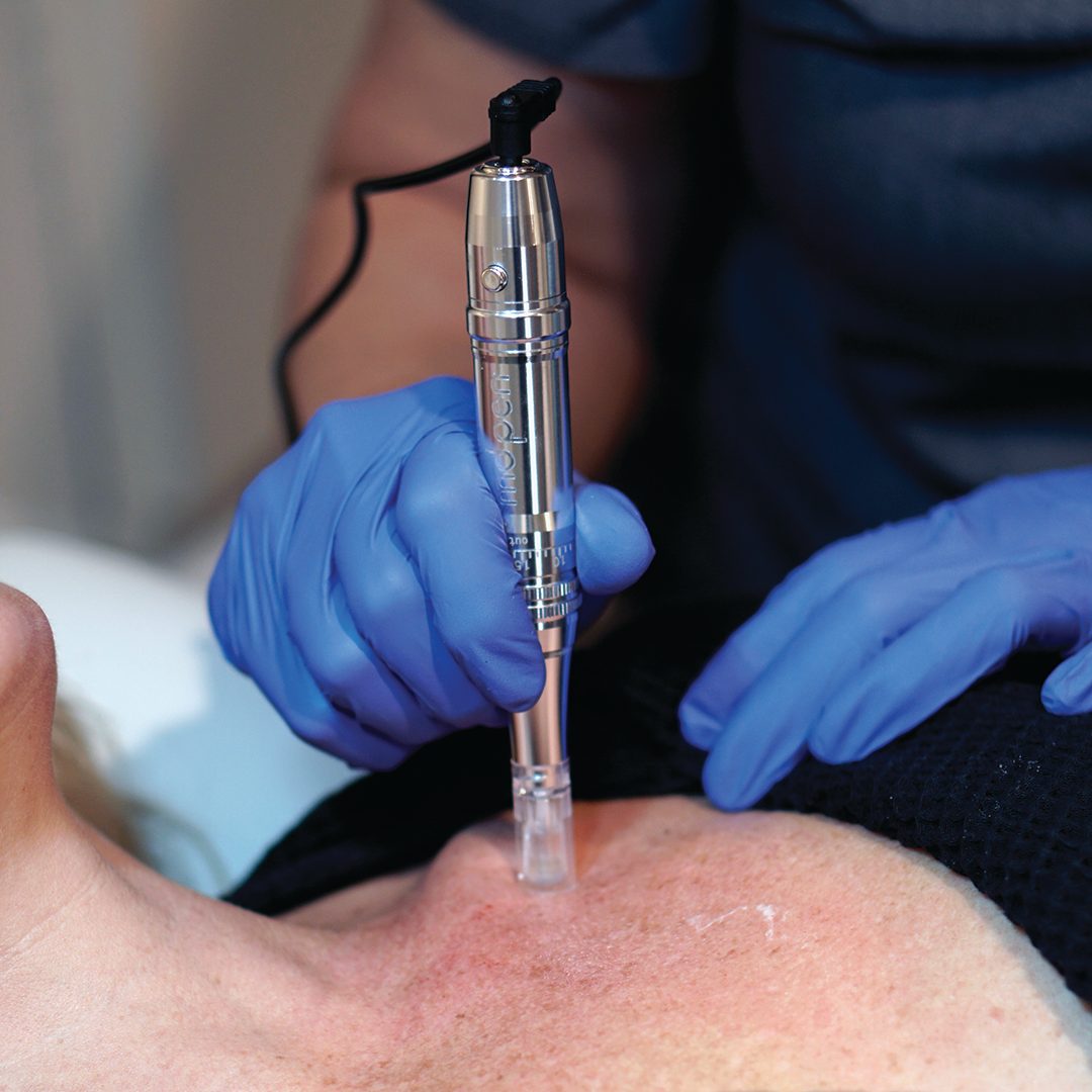 Microneedling treatment with a medical-grade pen at Resonance Wellness
